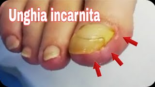 Unghia incarnita e dolorosa guida tutorial step by step [upl. by Andrey]