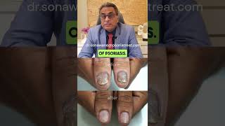 Effective Homeopathic Treatment for Nail Psoriasis  Before amp After Results [upl. by Adnirak335]