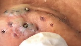 Big Cystic Acne Blackheads Extraction Blackheads amp Milia Whiteheads Removal Pimple Popping  5292 [upl. by Lefton235]