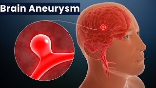 Brain Aneurysm Causes Signs and Symptoms Diagnosis and Treatment [upl. by Akinehc909]