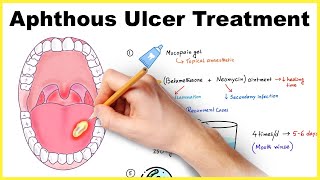 Aphthous ulcer stomatitis Canker sore treatment [upl. by Daniell]