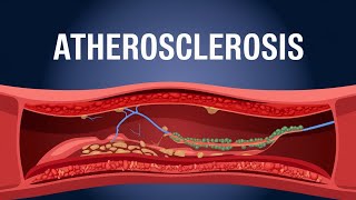 Atherosclerosis animation understanding Atherosclerosis [upl. by Anelrahc601]