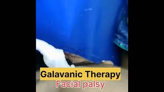 Facial nerve palsy [upl. by Amada]