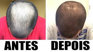 Evolução do tratamento  Antes e Depois  Minoxidil Kirkland  Cabelo  4 Meses [upl. by Roht]