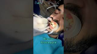 Braces Procedure holistic foryou braces dentalcare dentist [upl. by Eehc]