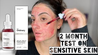 THE ORDINARY AHA 30  BHA 2 PEELING SOLUTION ON ACNE PRONE SENSITIVE SKIN  2 Month Test [upl. by Rotberg272]