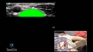 How To Ultrasound Guided Femoral Nerve Block 3D Video [upl. by Ahsuatan]