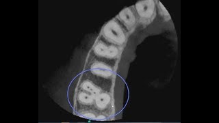 CS 81003D Endodontic 5 Canal Case [upl. by Hiasi]