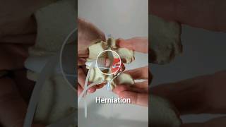 Degenerated Disc Model with Disc Herniation and Medial Branches [upl. by Anasiul]