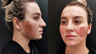 Acne Scar Removal with CO2 Laser Treatment  Before amp After [upl. by Mullen719]