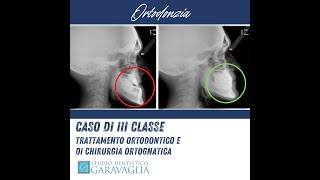 ortodonzia prima e dopo caso III classe dentale e scheletrica [upl. by Norrad]