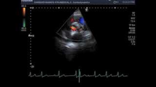 Biological Prosthetic Aortic Valve Malfunction [upl. by Bruner]