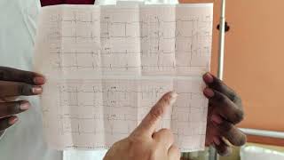 T wave inversion Can it be a normal finding on ECG dr Seema kale [upl. by Shute]