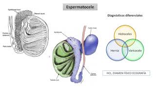 Quiste simple de Epidídimo y Espermatocele [upl. by Plossl202]