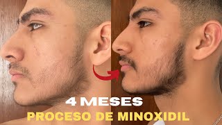 4 MESES USANDO MINOXIDIL PARA CRECER BARBA SIENDO 100 LAMPIÑO [upl. by Kiefer]