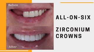 All on Six Treatment in Turkey  Dental Excellence Turkey Review [upl. by Crowns]