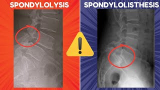 Spondylolysis vs Spondylolisthesis  Definitions Diagrams and Radiographic Appearances [upl. by Zobe]