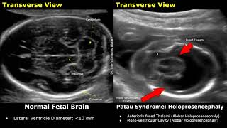 Fetal Ultrasound Normal Vs Patau Syndrome Imaging Findings  Holoprosencephaly amp Other Abnormalities [upl. by Coward214]