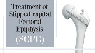 treatment of slipped capital femoral epiphysis SCFE  hip pain in children [upl. by Melisse66]