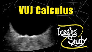 Vesicoureteric Junction VUJ Calculus  Ultrasound  Case 72 [upl. by Mariann]