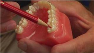 Tooth amp Gum Abscesses  How Dentists Drain an Abscessed Tooth [upl. by Cichocki]