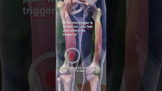 Are Vastus Medialis Trigger Points Causing Your Knee Pain [upl. by Suinotna]