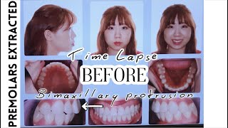 Braces Time Lapse 2 years 8 months⎥4 Premolars Extracted Bimaxillary Protrusion Side Profile [upl. by Finnie]