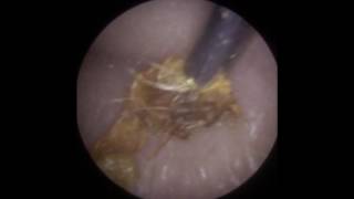 Long Strands of Ear Wax Removed using iCLEARscope®  Mr Neel Raithatha The Hear Clinic [upl. by Aiksa]