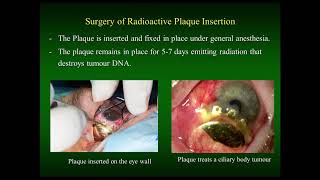 Uveal Melanoma Webinar Treatment Updates and Genetics [upl. by Druci575]