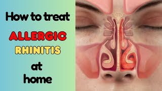 Allergic rhinitis hay fever symptoms home remedies natural remedies homeopathic remedies [upl. by Aivad425]