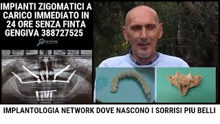 Implantologia Dentale  Prezzi Costi Intervista Angiolino [upl. by Zea752]