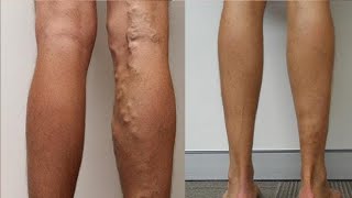 how to get rid of varicose veins on legs permanently [upl. by Arramat]