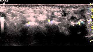 Ultrasound of a Mortons Neuroma and Mulders click test  Dr Peter Resteghini [upl. by Harlie]