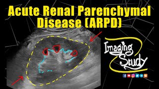 Acute Renal Parenchymal Disease  Ultrasound  Case 333 [upl. by Durstin]