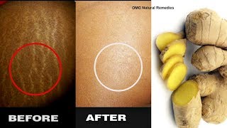 Fantastic In 5 days Get Rid Of Stretch Marks Fast II Remedy To Remove Stretch Marks [upl. by Hanad]