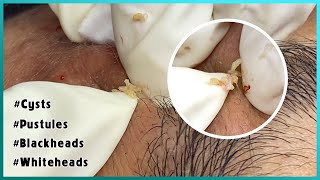 Big Cystic Acne Blackheads Extraction Blackheads amp Milia Whiteheads Removal Pimple Popping [upl. by Gnep]