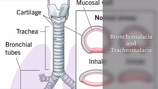 Bronchomalacia and Tracheomalacia [upl. by Borgeson]