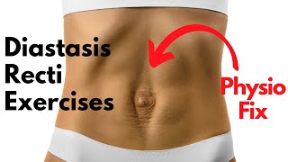 How to START Diastasis Recti Exercises that FIX YOUR GAP  PHYSIO GUIDED Abdo Separation Repair [upl. by Eluk]