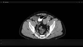 abdominal fascia on CT [upl. by Nanek68]