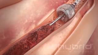 MegaVac Thrombectomy System [upl. by Ahsha397]