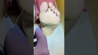 How to do Diabetic foot exam [upl. by Ernestus]