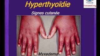 Hyperthyroidie Maladie de Basedow symptomes Endocrinologie Pathologie de la Thyroïde Cours medecine [upl. by Evilc872]