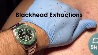 FULL VIDEO Ultimate Blackhead Banishment Professional Back Extractions Revealed Blackhead Revenge [upl. by Nee]