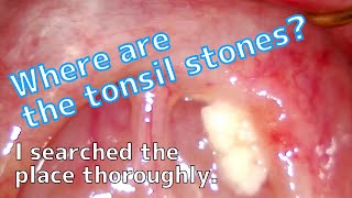 Where are the Tonsil stones hiding 【I searched thoroughly】 [upl. by Nylrem]