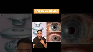 Trasplante con CORNEA de TITANIO ¿Es POSIBLE Restaurar la Visión [upl. by Rofotsirk744]