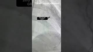 SP CABG AFTER GRAFT ANGIOGRAPHY  WHAT GONE HAPPENED [upl. by Erreip]