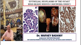 EPITHELIAL NEOPLASMS OF THE OVARY HIGH GRADE SEROUS CARCINOMA BY DR WAFAEY BADAWY [upl. by Oaht]