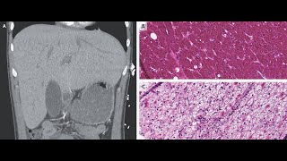 Glykogen Hepatopathie [upl. by Thorlay894]