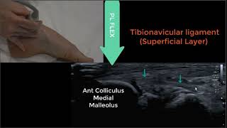 Deltoid Ligament Ultrasound 2023 [upl. by Nrubliw]