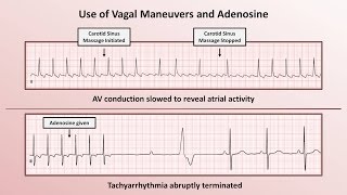 Intro to EKG Interpretation  How to Identify Any Tachyarrhythmia with 6 Easy Questions [upl. by Anilorak]